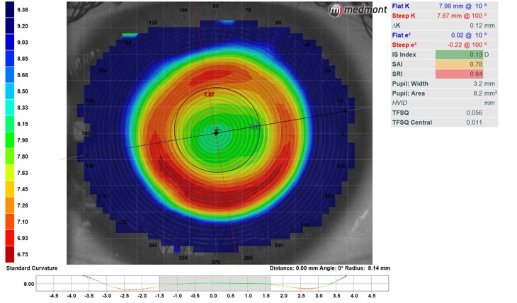 orthoK perfect Map Cropped
